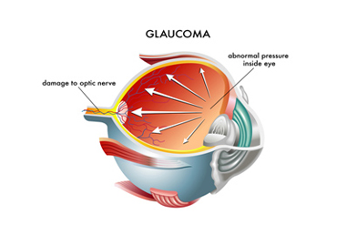 glaucomaa