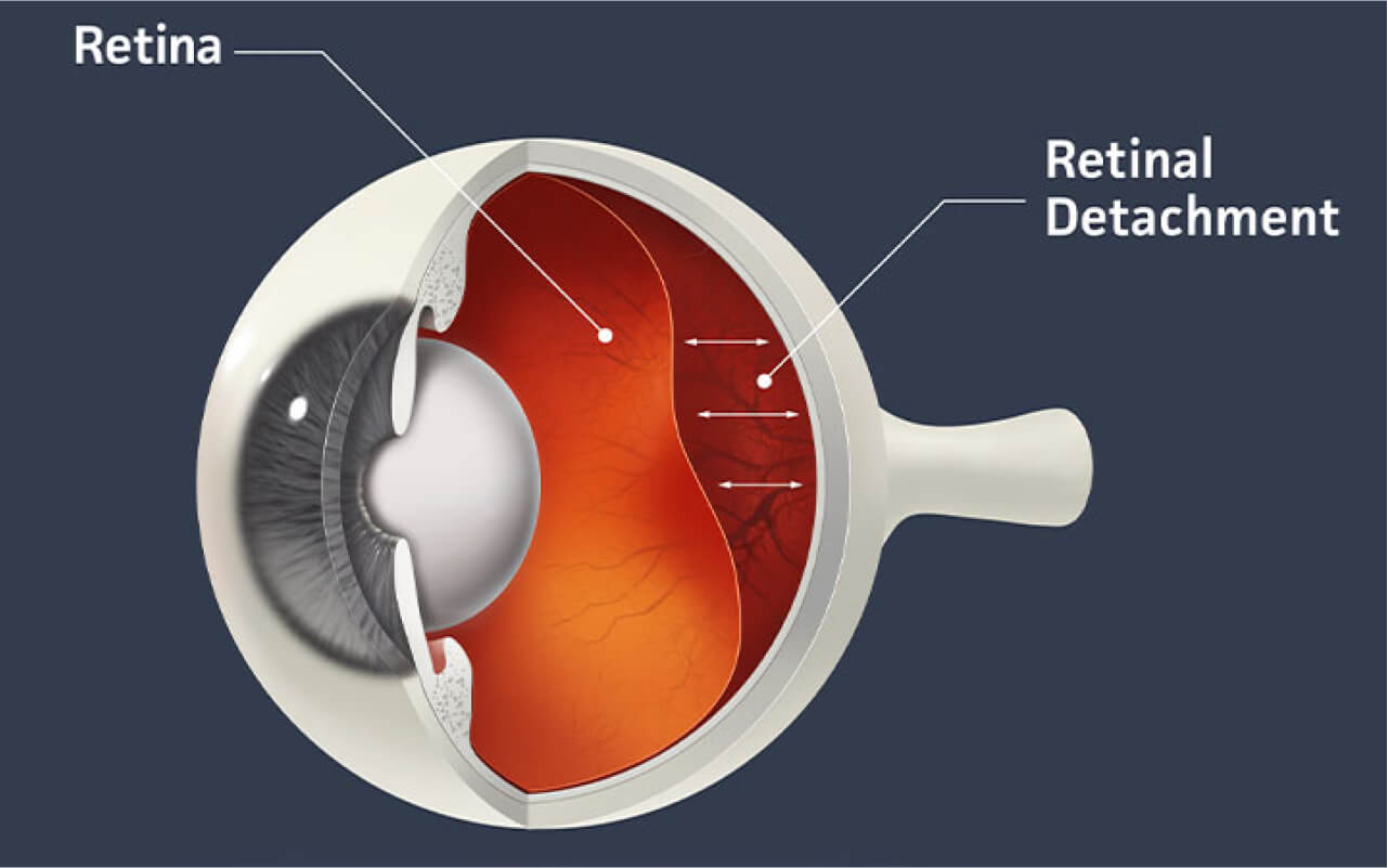 RETINAMATA-klinikmatajombang